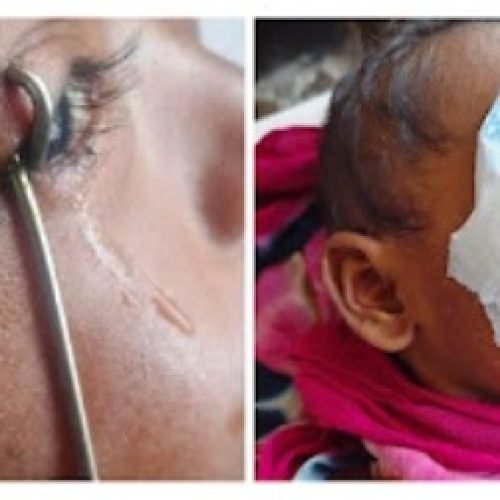 मासूम की आंख में फंसी टंग क्लीनर, जिला अस्पताल में सफल ऑपरेशन कर बचाई गई आंख…
