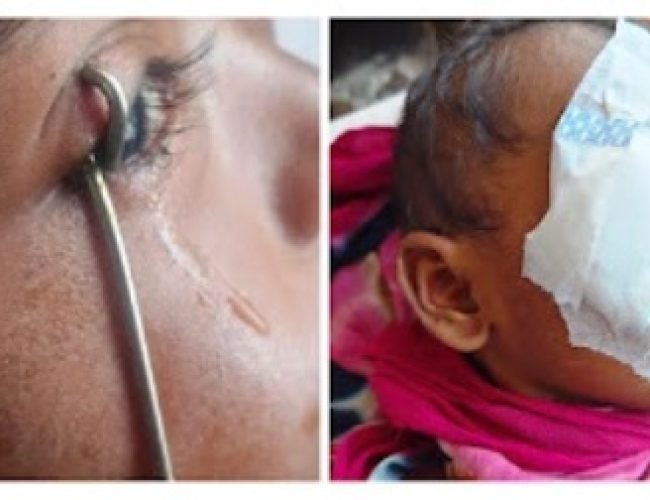 मासूम की आंख में फंसी टंग क्लीनर, जिला अस्पताल में सफल ऑपरेशन कर बचाई गई आंख…