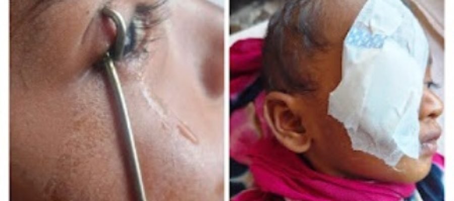 मासूम की आंख में फंसी टंग क्लीनर, जिला अस्पताल में सफल ऑपरेशन कर बचाई गई आंख…